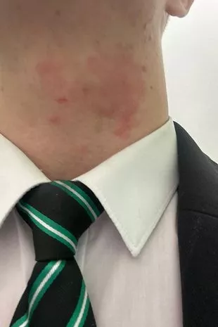 一名15岁的男生因为生病需要剪一个“极端”的发型而翘课