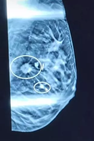 当我发现肿块时,医生说我“反应过度”,然后我得到了一个毁灭性的消息